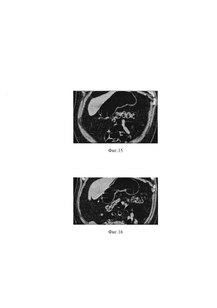 Способ компьютерно-томографического исследования желудка (патент 2621952)