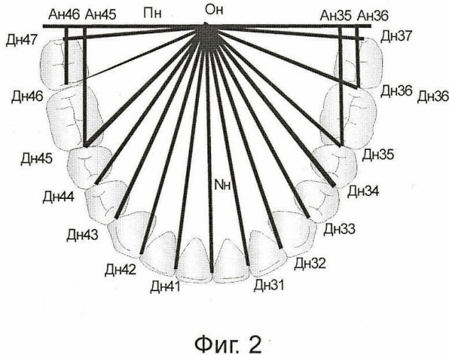 Способ биометрической ортодонтической диагностики на моделях челюстей (патент 2446739)
