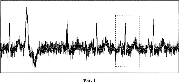 Способ обработки электрокардиосигнала (патент 2503401)