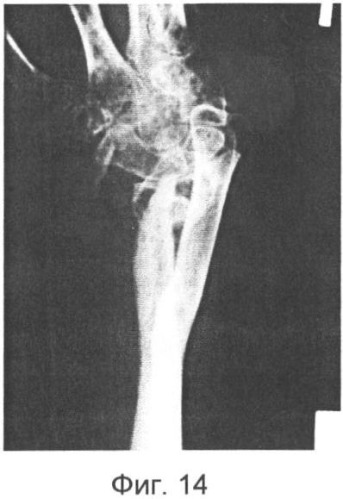 Способ лечения дефектов костей предплечья (патент 2350294)