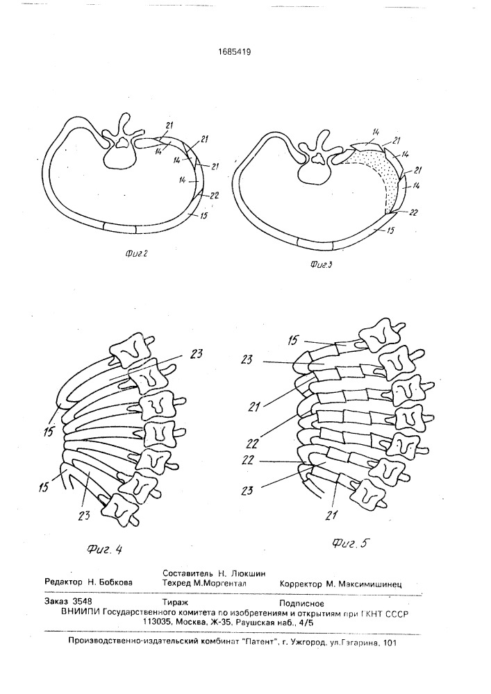 Способ торакопластики при сколиозе и устройство для его осуществления (патент 1685419)