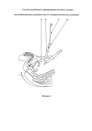Способ надлобкового дренирования мочевого пузыря с внутрибрюшинным разрывом при его лапароскопическом ушивании (патент 2592023)