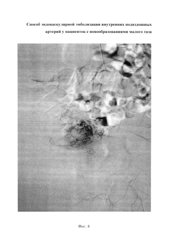 Способ эндоваскулярной эмболизации внутренних подвздошных артерий у пациенток с новообразованиями малого таза (патент 2576092)