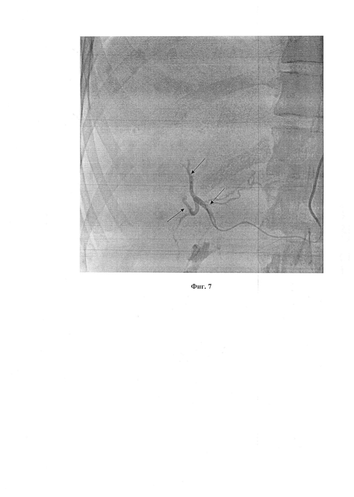 Способ рентгенэндоваскулярной эмболизации висцеральных ветвей через артерии верхних конечностей при помощи катетера headhunter при различных патологиях желудочно-кишечного тракта (патент 2652743)