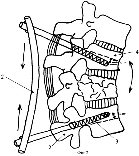 Способ лечения множественных переломов позвоночника у детей (патент 2370236)