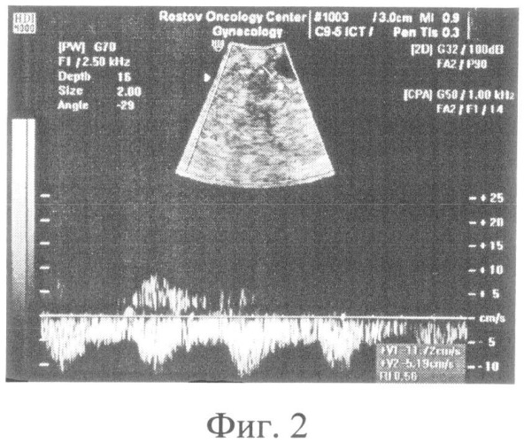 Способ ультразвуковой диагностики локальных рецидивов рака яичников (патент 2498773)