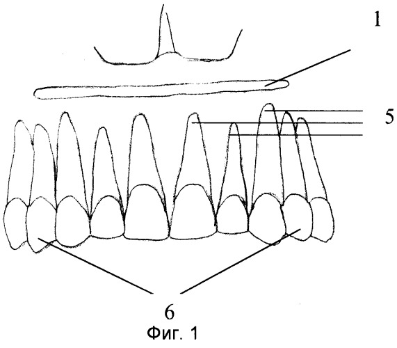 Способ лечения протрузии зубов (патент 2297194)