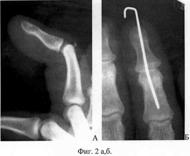 Способ лечения повреждений сухожилия разгибателя пальца кисти (патент 2334479)