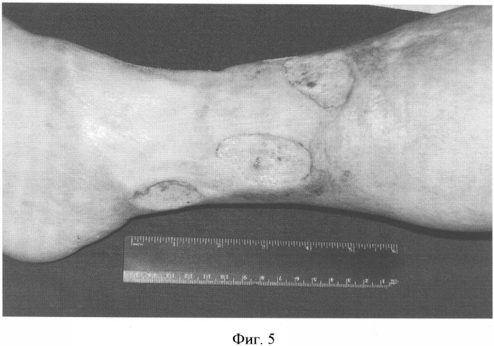Способ лечения трофических язв нижних конечностей при посттромботической болезни (патент 2328288)