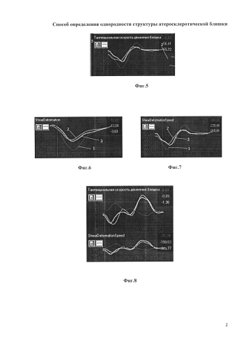 Способ определения однородности структуры атеросклеротической бляшки (патент 2584135)