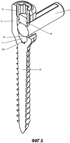 Имплантат с многоосной головкой для закрепления в кости (патент 2302839)