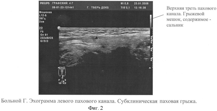 Способ диагностики субклинических форм врожденных паховых грыж (патент 2438584)