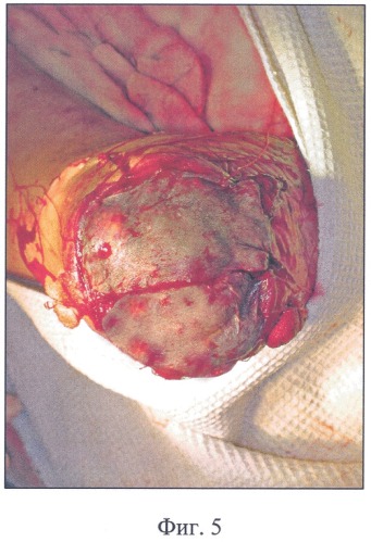 Способ хирургического лечения хронического концевого остеомиелита опилов плюсневых костей с обширным мягкотканым дефектом культи стопы (патент 2327429)