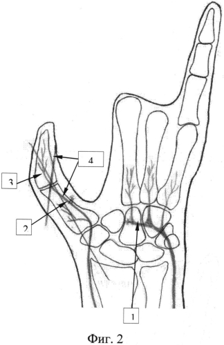 Способ формирования первого пальца кисти (патент 2570770)