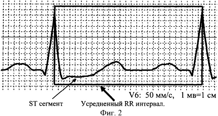 Способ представления электрокардиосигнала (патент 2363379)