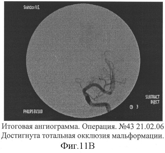 Способ эмболизации артериовенозных мальформаций головного мозга в условиях общей анестезии и управляемой гипотонии (патент 2315634)