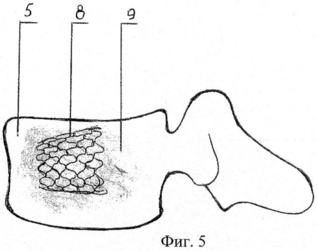 Способ восстановления тела позвонка при компрессионных переломах (патент 2456947)