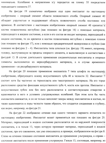 Имплантаты для создания соединений с тканями, в частности со скелетом, а также устройство и способ имплантации (патент 2314768)