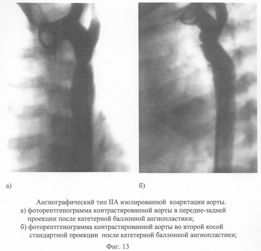 Способ диагностики изолированной коарктации аорты и способ выбора тактики ее лечения (патент 2244510)