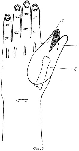 Способ реконструкции пальца при наличии дефекта мягких тканей кисти (патент 2479260)