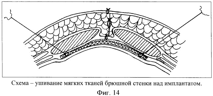 Способ размещения имплантата (патент 2445011)