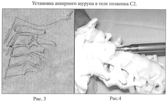 Способ анкерной коррекции и фиксации травматических дислокаций тела позвонка с2 при переломах палача (патент 2463978)