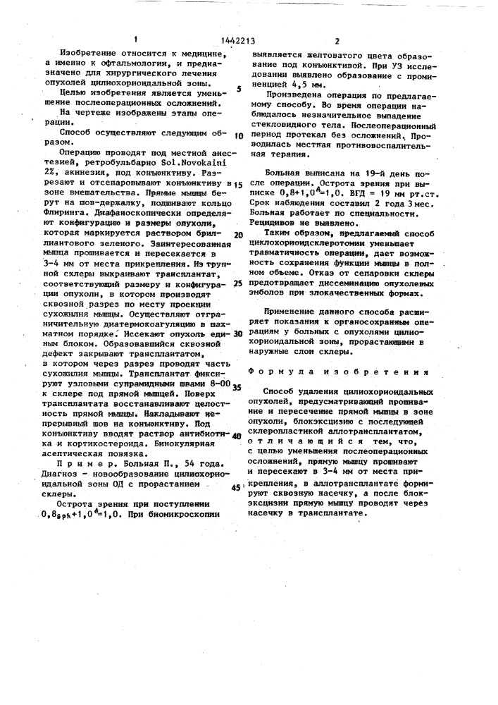 Способ удаления цилиохориоидальных опухолей (патент 1442213)