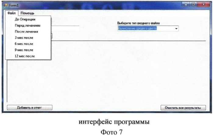 Способ динамического контроля за состоянием диска зрительного нерва при заболеваниях зрительного нерва. (патент 2556567)