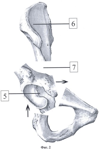 Способ выполнения транспозиции вертлужной впадины в ходе тройной остеотомии таза (патент 2432132)