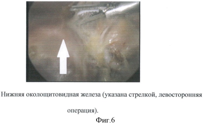 Способ эндовидеохирургической гемитиреоидэктомии (патент 2511461)