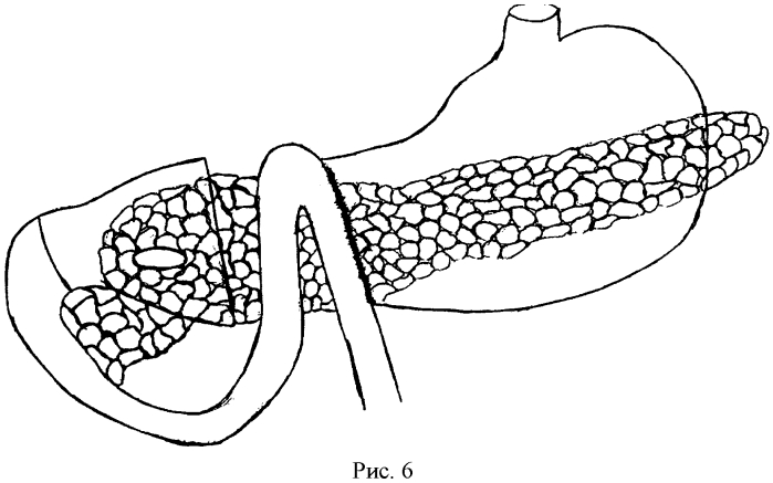 Способ хирургического лечения кист головки поджелудочной железы (патент 2571711)