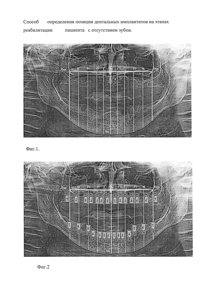 Способ определения позиции дентальных имплантатов на этапах реабилитации пациента с отсутствием зубов (патент 2665141)
