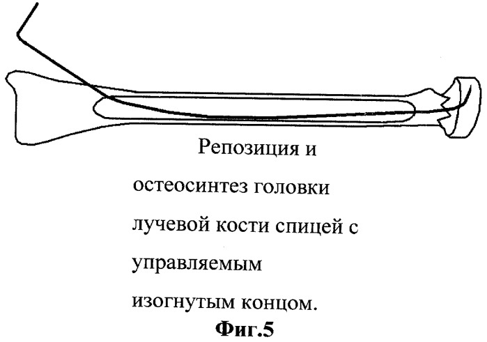 Репозиция костей. Что такое металлоостеосинтез головки лучевой кости. Остеосинтез лучевой кости спицами. Остеосинтез головки лучевой кости.