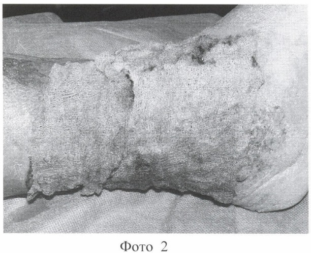 Композиция для лечения гнойных ран и трофических язв (патент 2384338)
