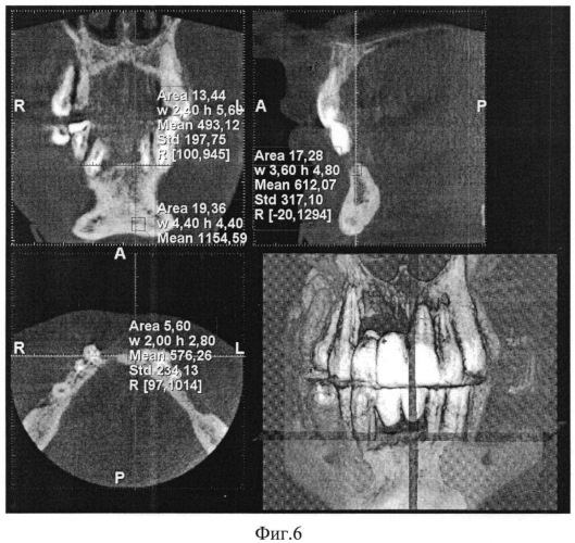 Способ восстановления тканей зубочелюстной системы (патент 2551312)