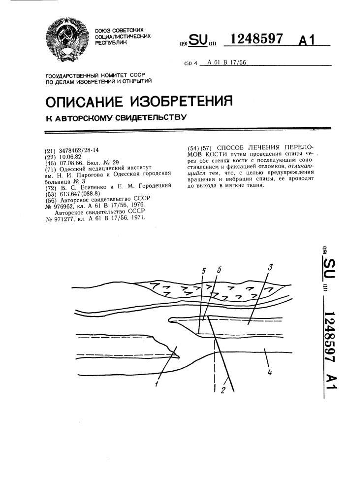 Способ лечения переломов кости (патент 1248597)