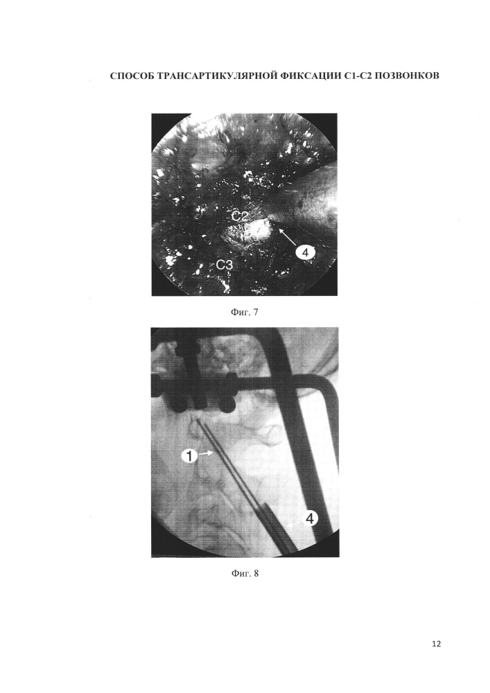 Способ выполнения трансартикулярной фиксации с1-с2 позвонков (патент 2662203)