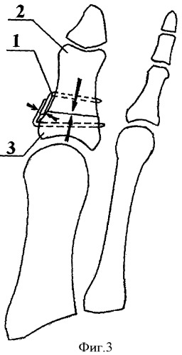 Способ оперативной коррекции вальгусной деформации первого пальца стопы (патент 2372043)