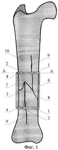 Фиксатор-стяжка для иммобилизации отломков трубчатых костей (патент 2311889)
