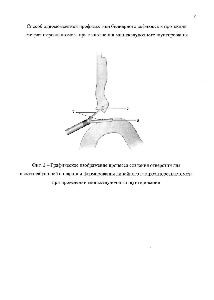 Способ одномоментной профилактики билиарного рефлюкса и протекции гастроэнтероанастомоза при выполнении минижелудочного шунтирования (патент 2629045)