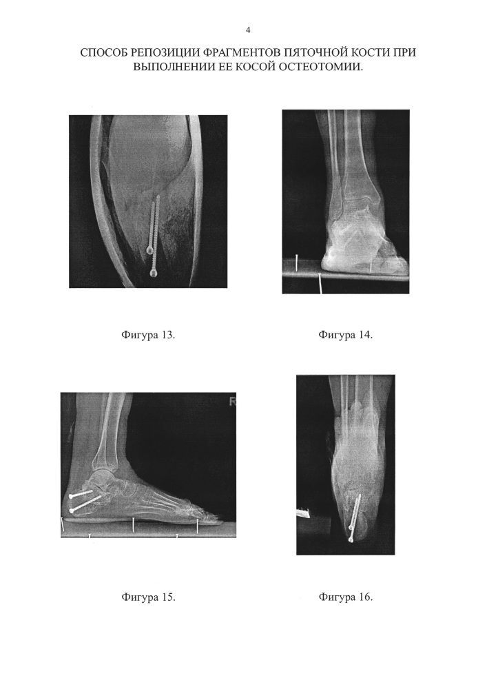 Способ репозиции фрагментов пяточной кости при выполнении ее косой остеотомии (патент 2661705)