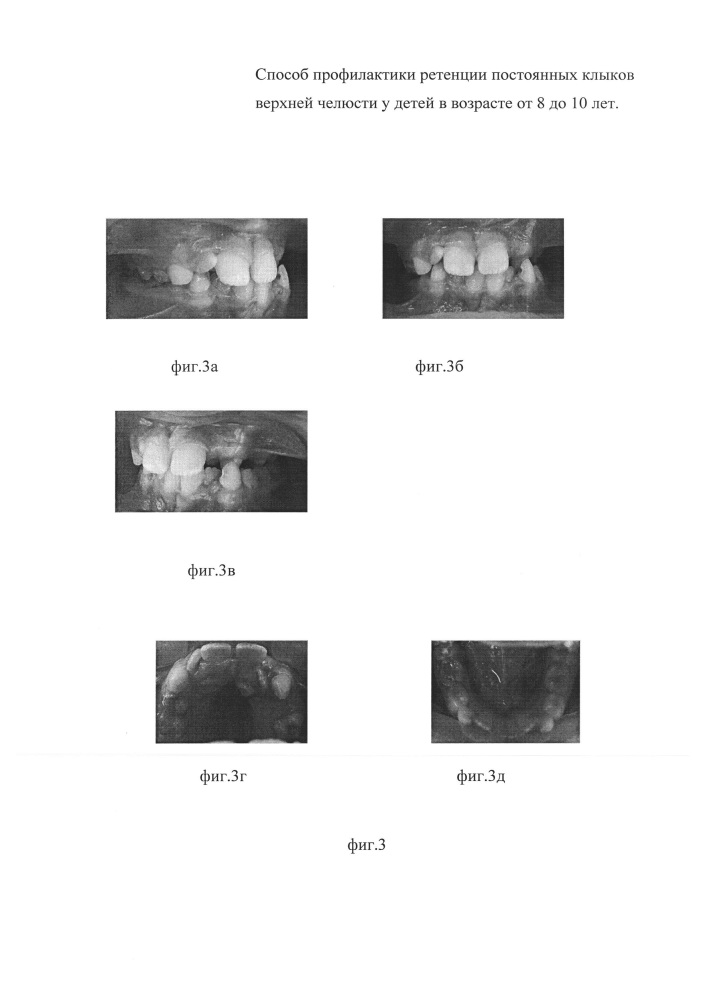 Способ профилактики ретенции постоянных клыков верхней челюсти у детей в возрасте от 8 до 10 лет (патент 2633479)