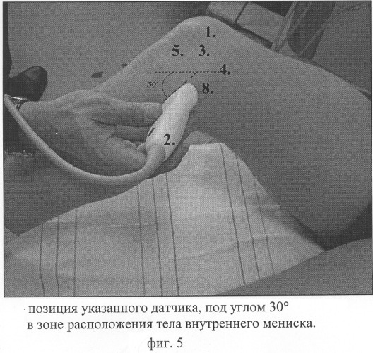 Способ комплексной ультразвуковой диагностики повреждения внутреннего мениска коленного сустава в области тела и переднего рога (патент 2305493)