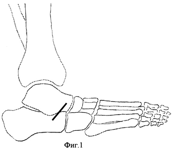 Способ оперативной коррекции деформаций стопы (патент 2412661)