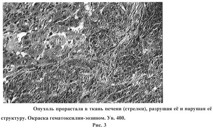 Способ получения метастазов печени в эксперименте (патент 2538243)