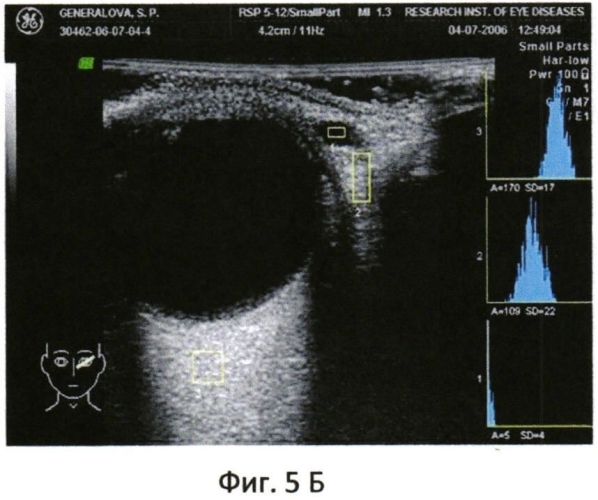 Способ диагностики поражения слезной железы на начальной стадии при синдроме шегрена (патент 2567280)