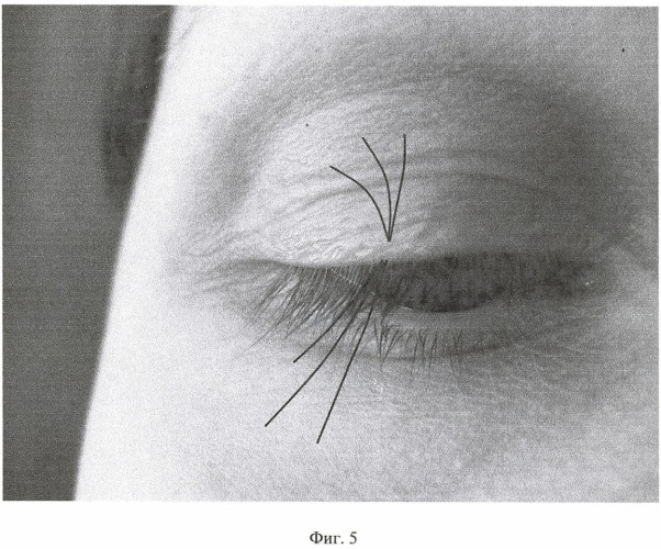 Способ имплантации ресниц (его варианты) (патент 2446751)