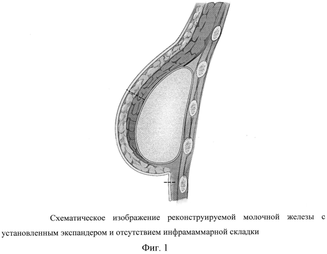 Способ формирования инфрамаммарной складки при двухэтапной реконструкции молочной железы (патент 2567790)