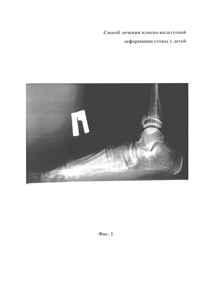 Способ лечения плоско-вальгусной деформации стопы у детей (патент 2602935)