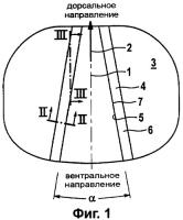 Межпозвонковые протезы с самонарезными фиксирующими выступами Межпозвонковые протезы с самонарезными фиксирующими выступами